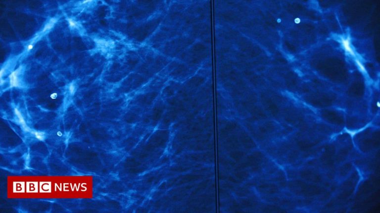 Breast cancer: The AI tool trained to spot the disease
